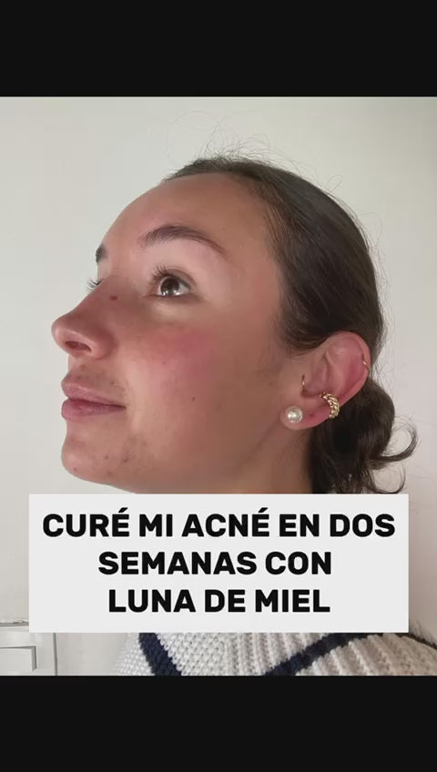 Como eliminar el acne